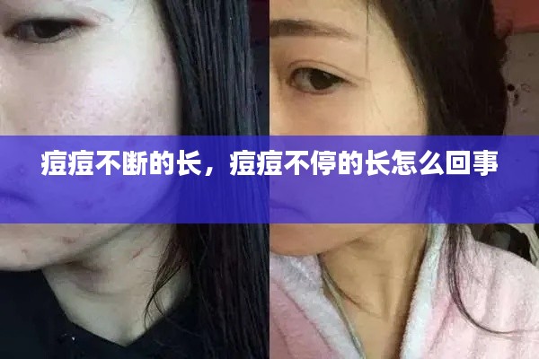 痘痘不断的长，痘痘不停的长怎么回事 