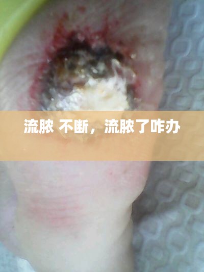 流脓 不断，流脓了咋办 