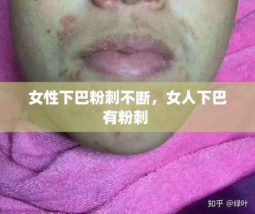 女性下巴粉刺不断，女人下巴有粉刺 